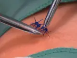 sutures get removed from a patient